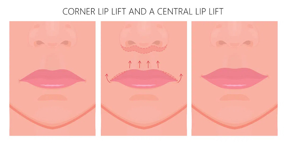 lip flip, lip flip treatment, thin lips