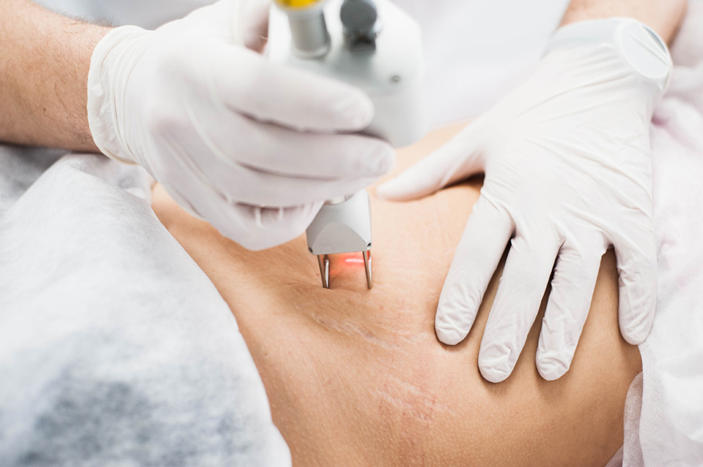 stretch marks treatment, improve skin texture, skin tone
