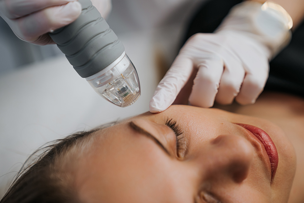 rf microneedling vs microneedling, rf microneedling, radiofrequency energy, deeper skin layers