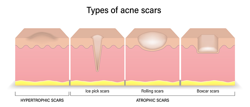 acne scars treatment, refine skin texture, smoother surface