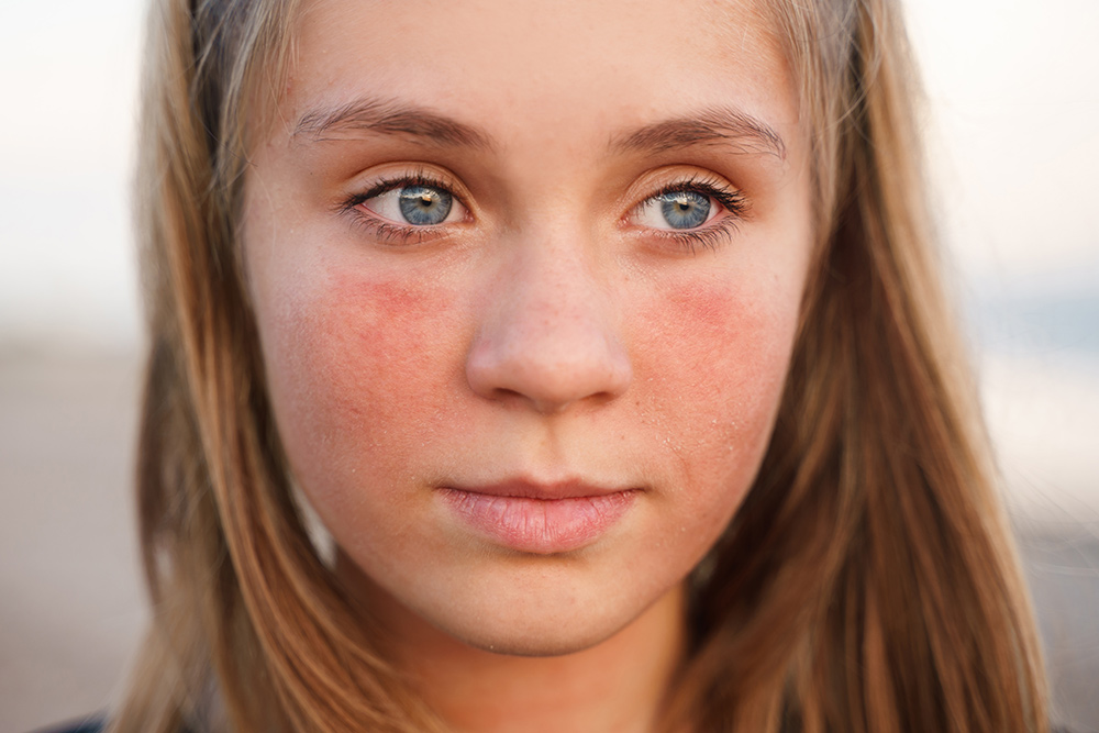 sun damage treatment, pigmentation, sun spots, uneven skin tone, UV exposure