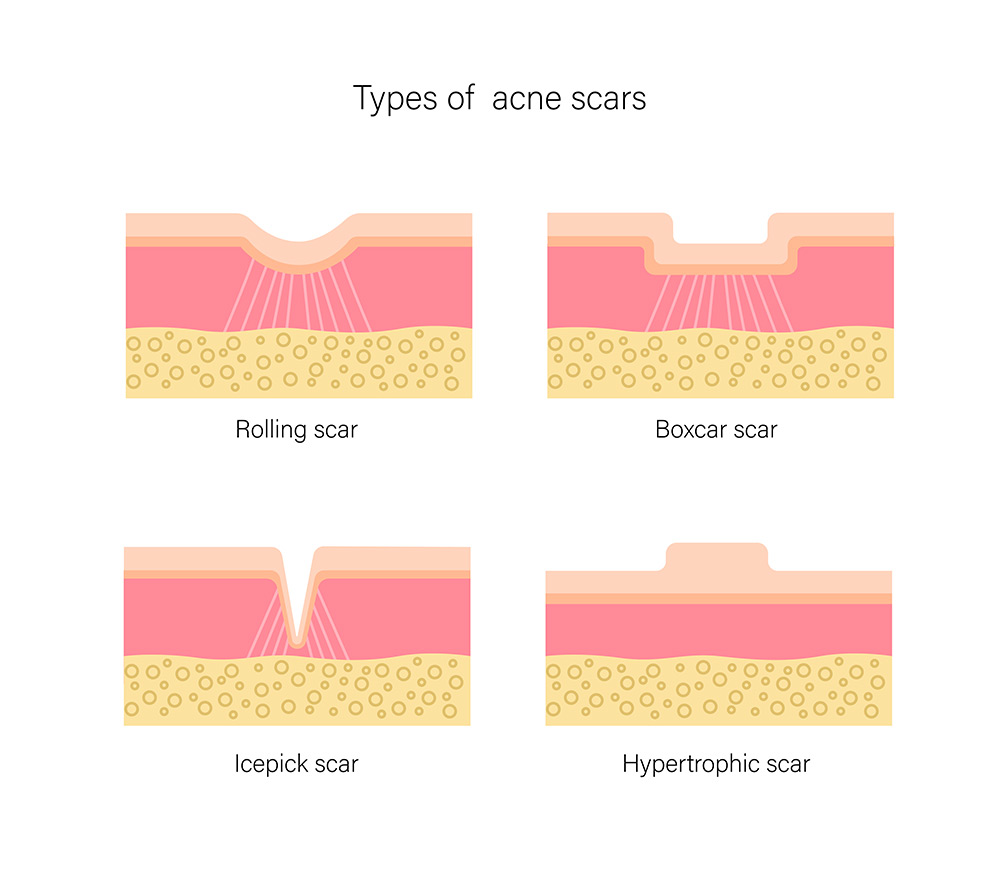 types of acne scars, ice pick scars, boxcar scars, rolling scars