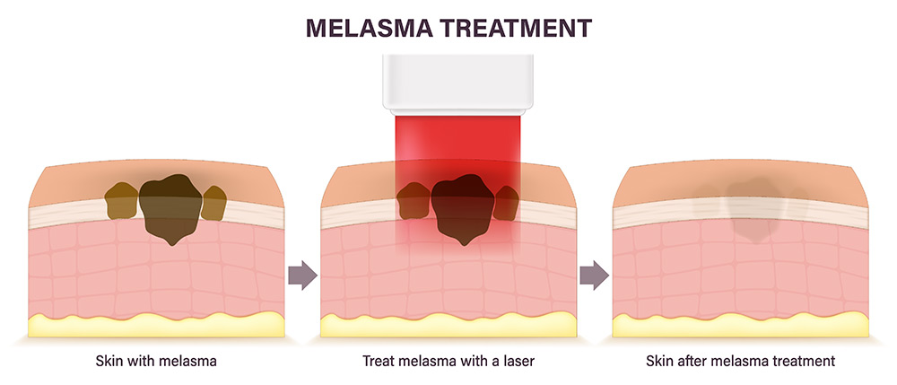 melasma treatment, melasma on face, facial melasma areas, melasma pigmentation