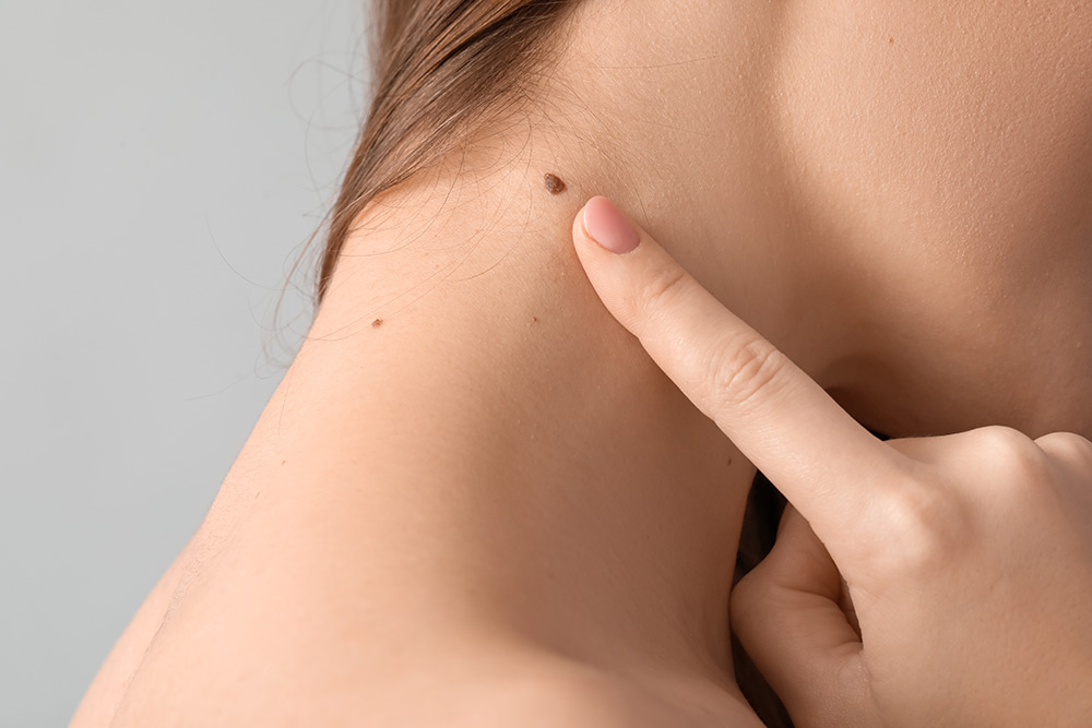 mole removal, facial mole removal, mole removal treatment areas, benign mole removal