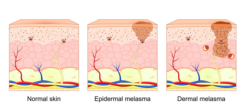 melasma treatment, melasma on face, facial melasma, melasma pigmentation