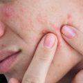 how to get rid of acne scars acne scars treatment acne scarring how to reduce acne scars