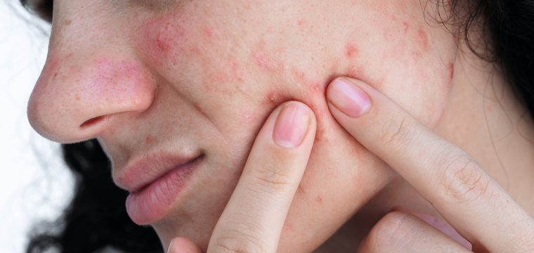 how to get rid of acne scars acne scars treatment acne scarring how to reduce acne scars