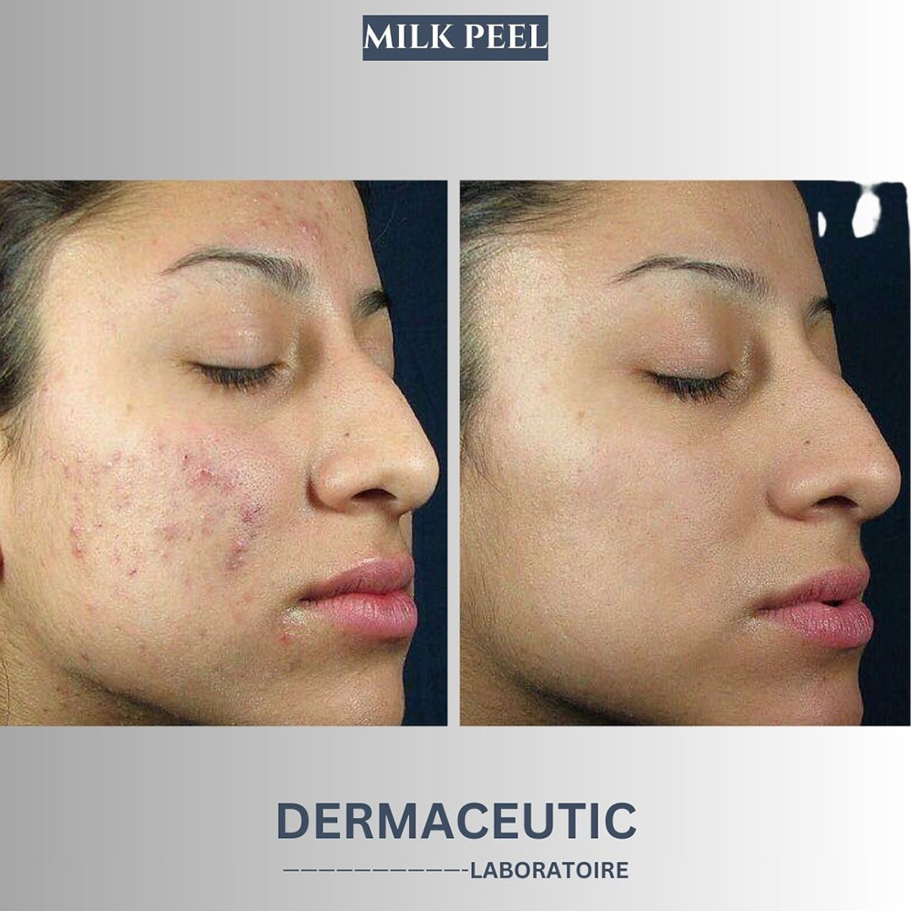 how to get rid of acne scars, acne scar healing, acne scar management, acne scars skin surface