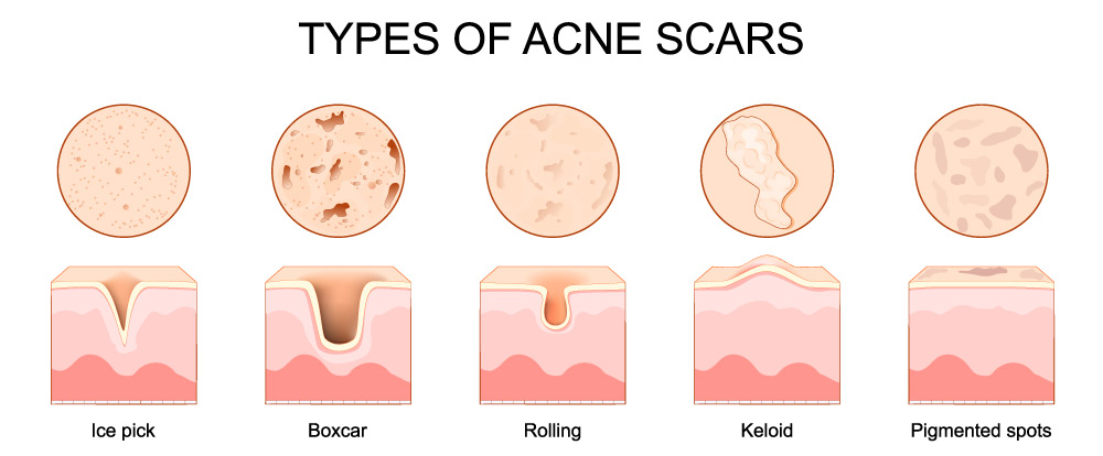 how to get rid of acne scars, acne scars on face, acne scarring, uneven skin texture acne scars