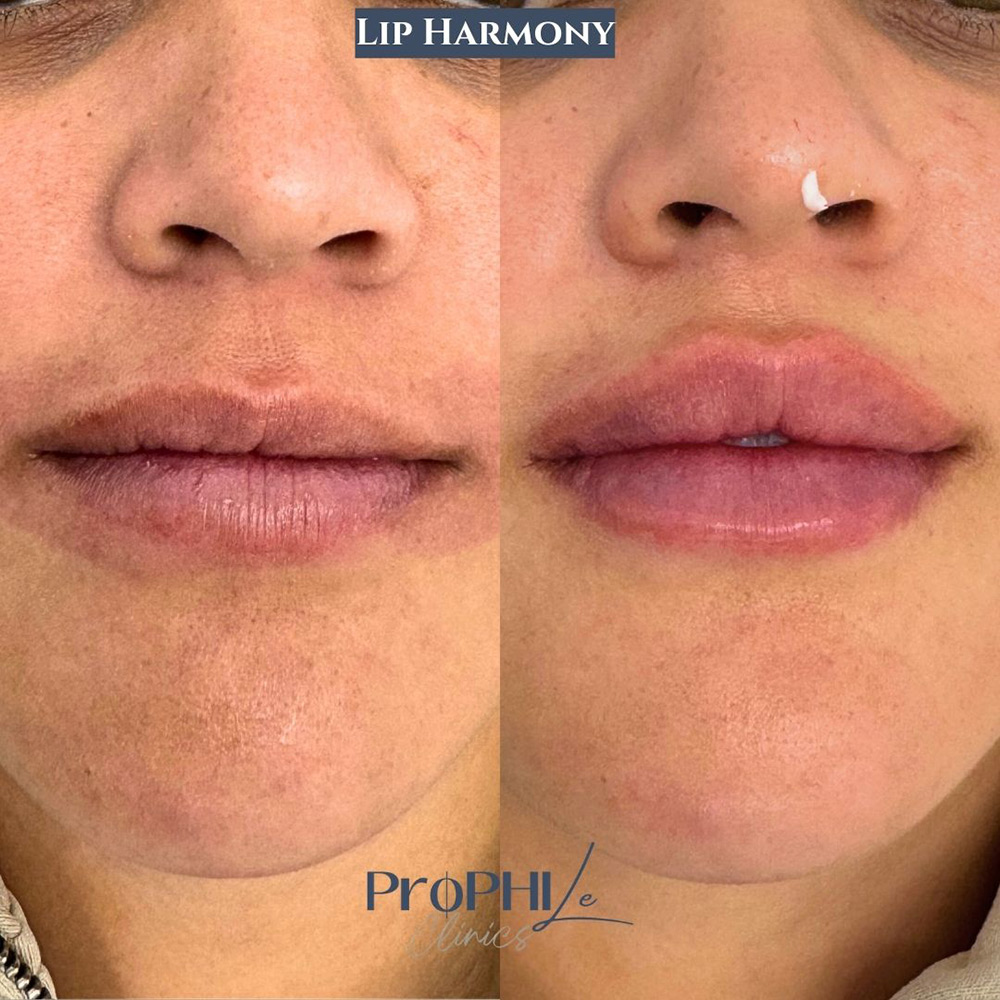 how to fix uneven lips, uneven lips, lip asymmetry, uneven lip shape