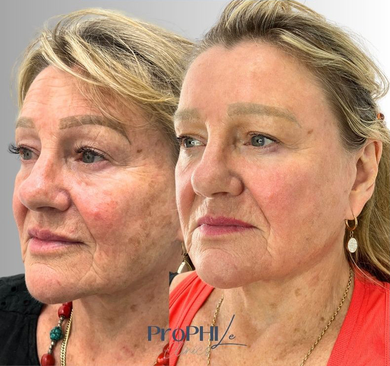 dull skin treatment, rough skin texture treatment, dull skin on face, rough skin texture on face