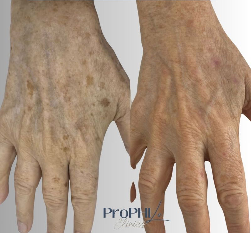 freckles vs age spots vs sun spots, sun exposure and skin tone, types of skin pigmentation