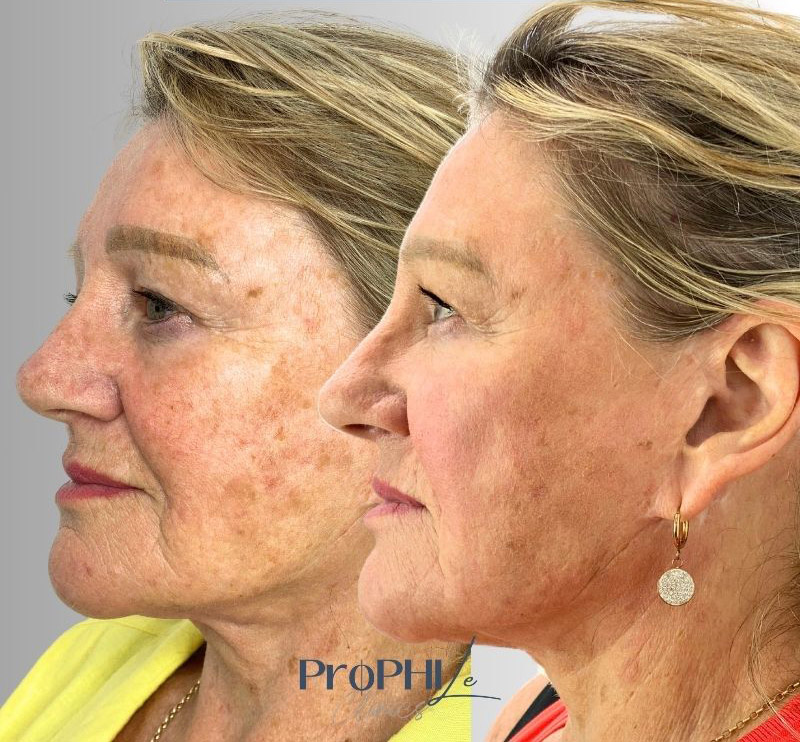 UV exposure and pigmentation, factors affecting skin tone, protecting skin from pigmentation