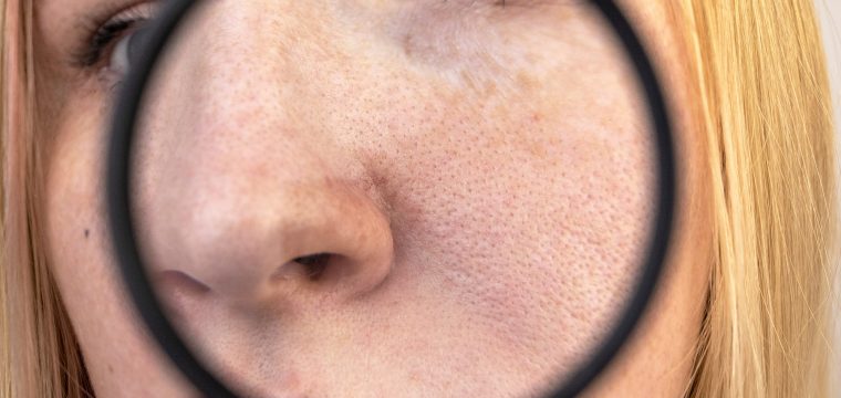 what causes enlarged pores, enlarged pores causes, visible facial pores, pore size factors