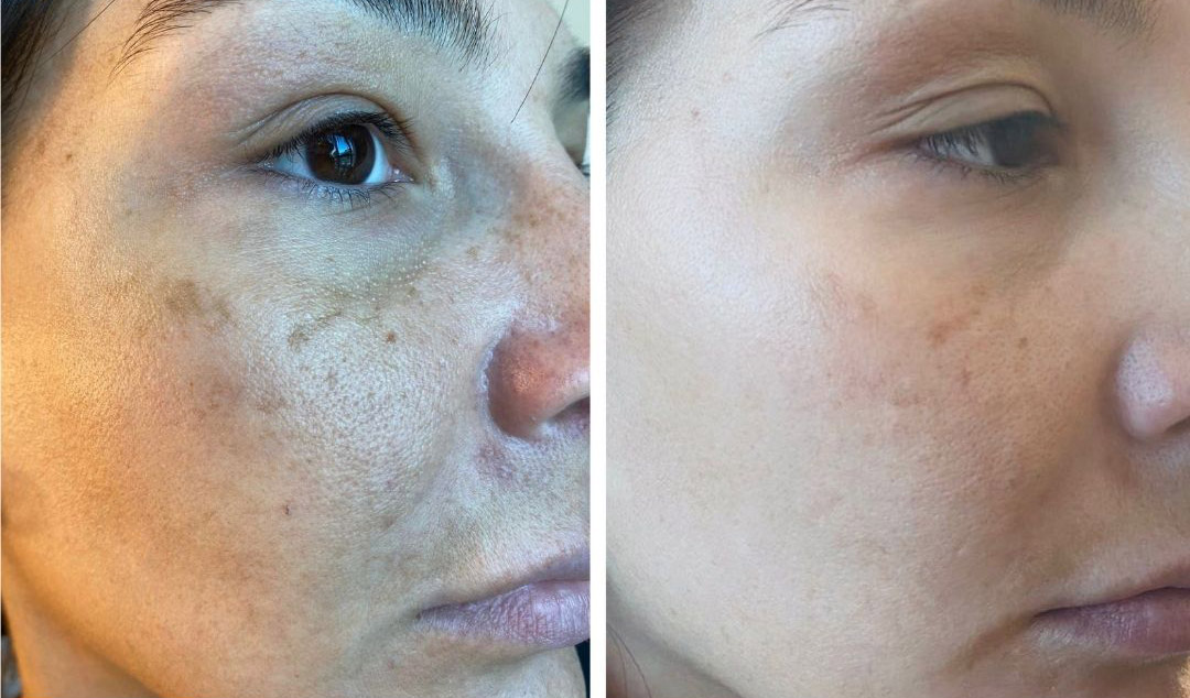 what causes melasma, melasma triggers, hormones and melasma, genetic melasma factors
