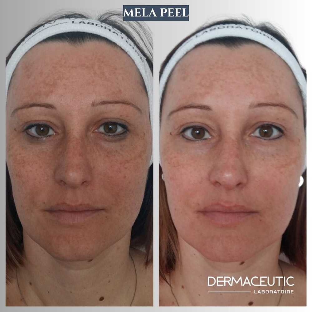 how do chemical peels work, chemical peel depth, professional chemical peel, skin exfoliation treatment