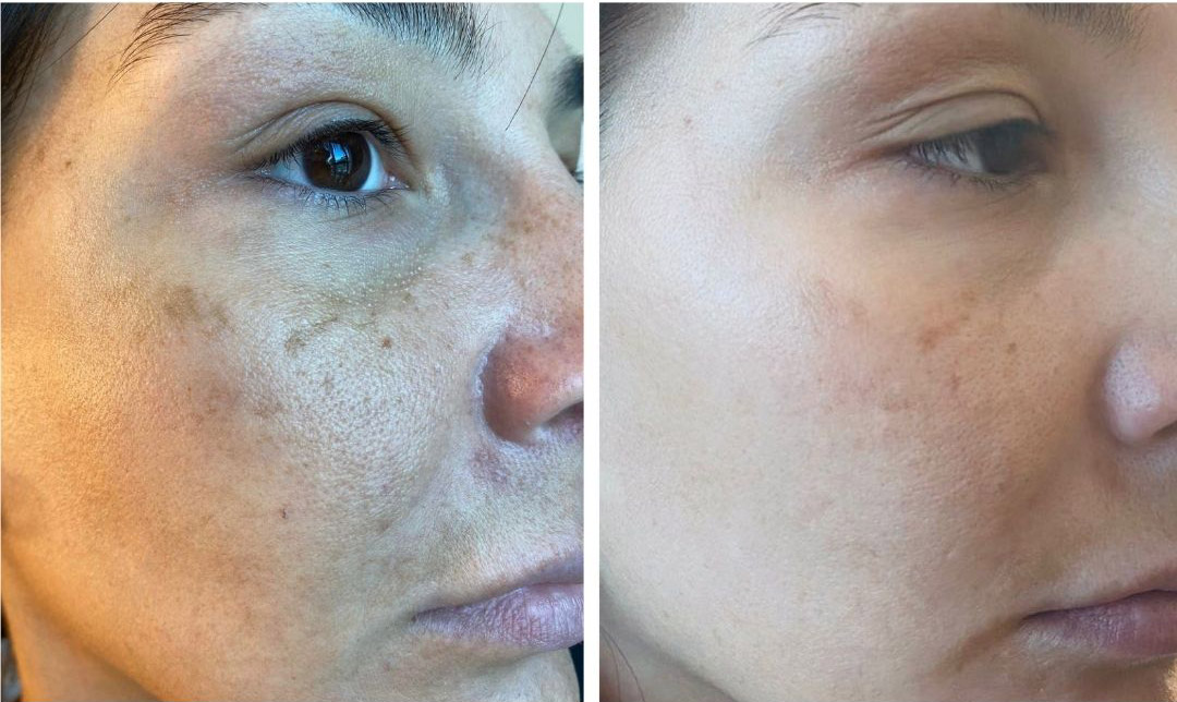 how to prepare for a chemical peel, irritated skin before a peel, chemical peel precautions, when to delay a chemical peel